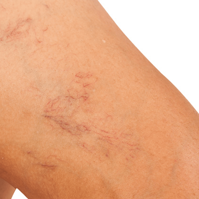 Vascular therapy Vancouver