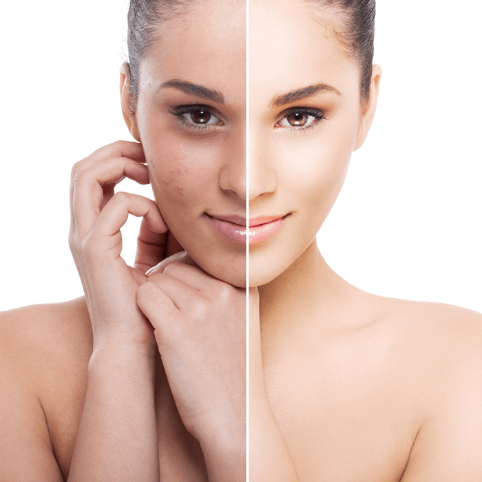 Concerns Hyperpigmentation