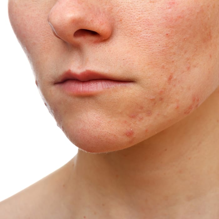 Vancouver acne laster treatment